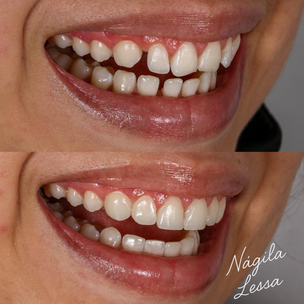 Antes e depois de facetas de resina — Dra. Nágila Lessa