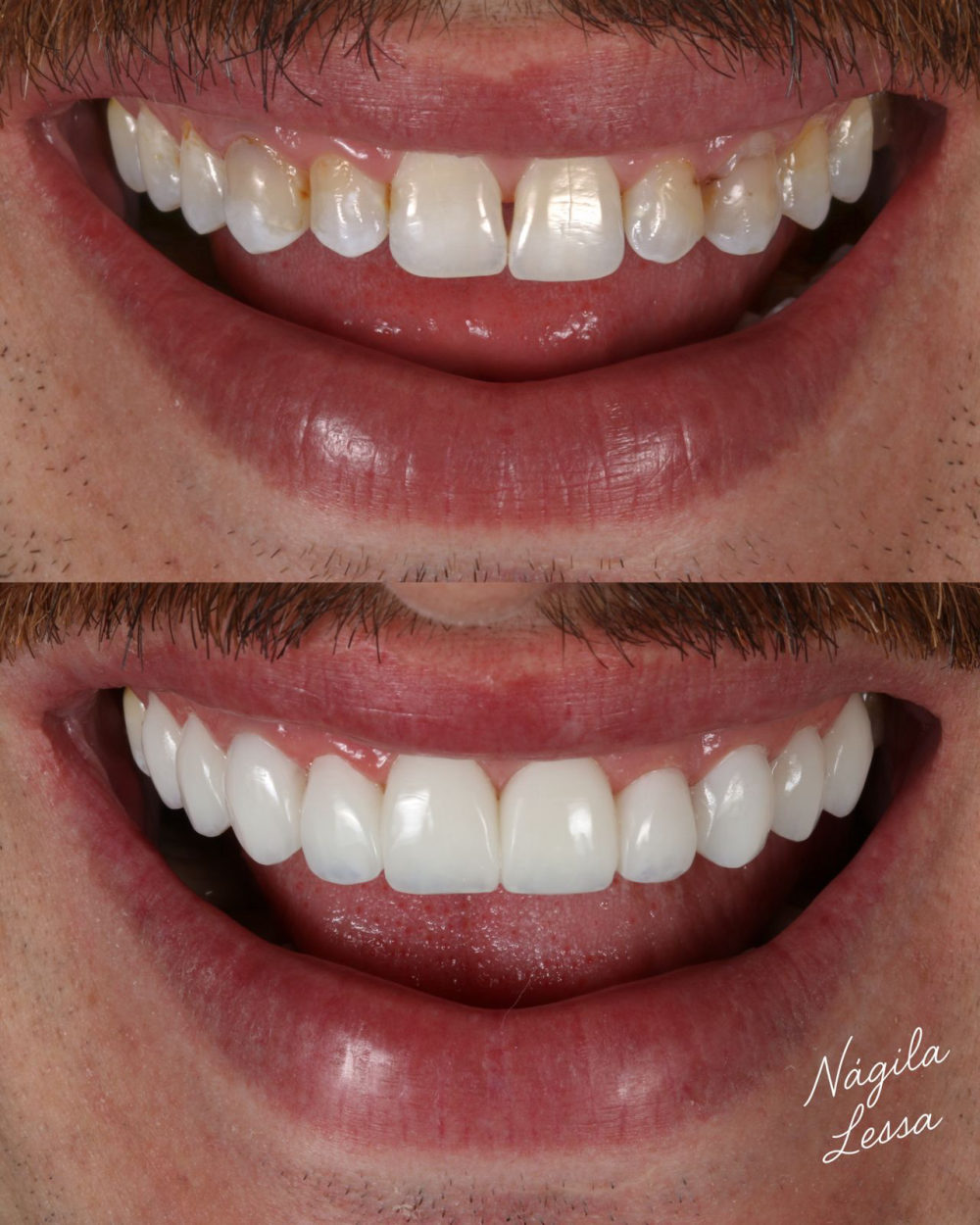 Antes e depois de facetas de resina — Dra. Nágila Lessa